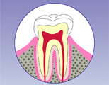 歯の天敵”虫歯は、治療をしないと治りません