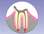 歯の天敵”虫歯は、治療をしないと治りません