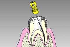 重度の虫歯は根から治します