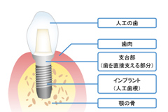 インプラントで快適な噛み心地を取り戻しましょう