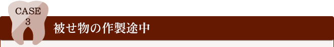CASE3	被せ物の作製途中