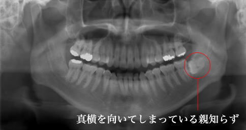 親知らずの抜歯について