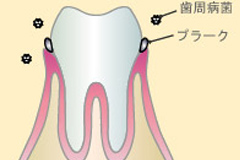 軽度の歯周炎