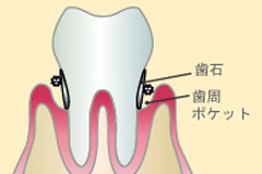 中等度の歯周炎