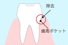 ルートプレーニング