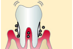 重度の歯周炎