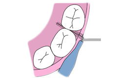 ご家庭ではフロスや歯間ブラシをお使いください